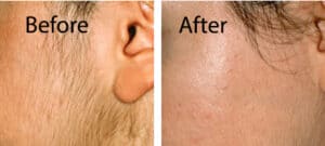 Hair removal results after and IPL treatment