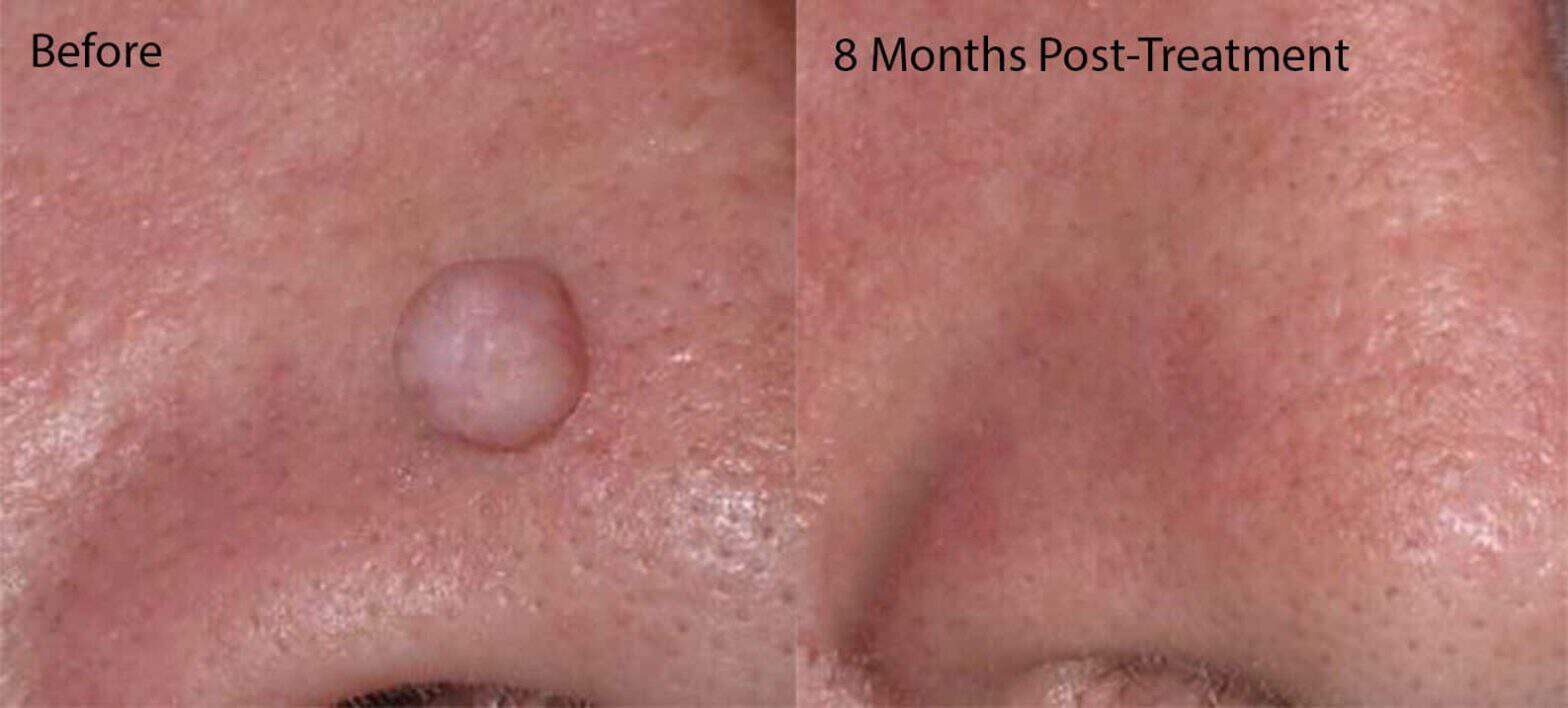Removing benign moles in an Ottawa Facial Plastic Surgery Clinic – Using Radio-Surgery to do this safely and without a scar
