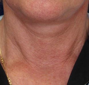 Aging Neck