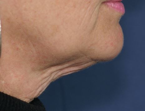 Aging Neck