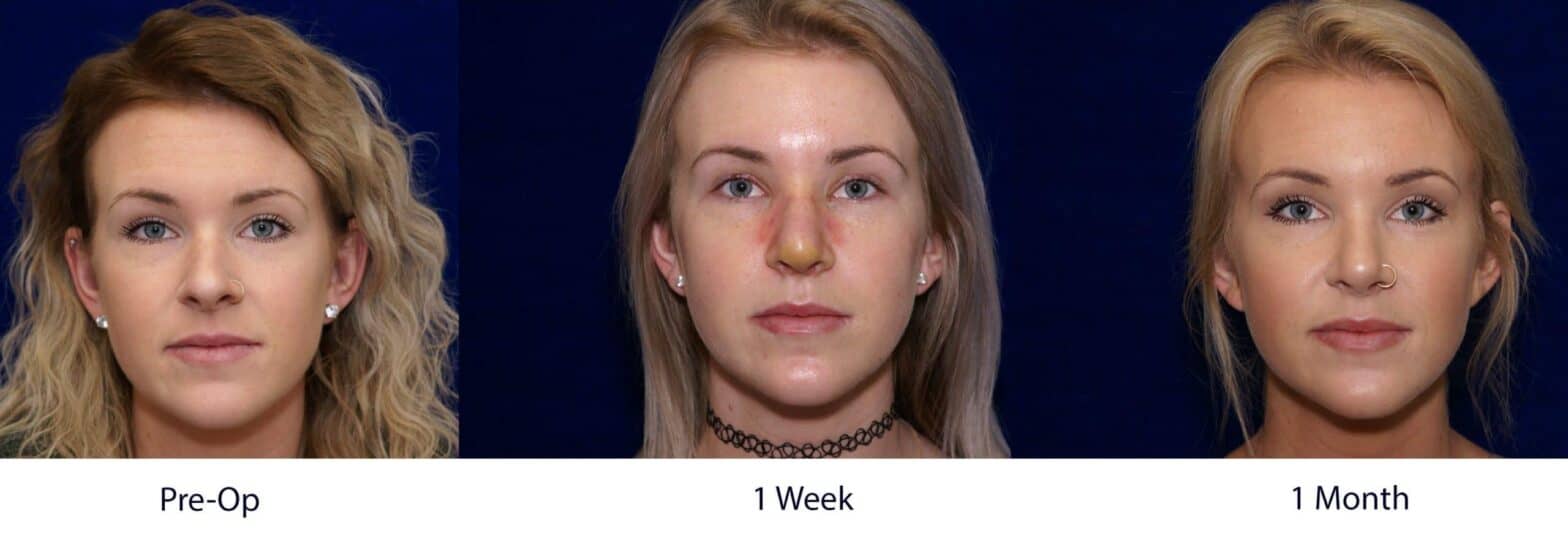 How Long does it Take to Heal From a Rhinoplasty