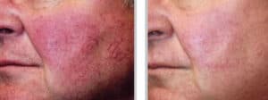 Treatment of Rosacea with IPL