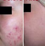 IPL treatment and Acne
