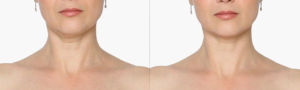 Contouring the Neck – Methods to remove fat from under the chin