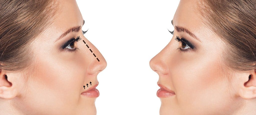 Rhinoplasty – A Patient’s Perspective