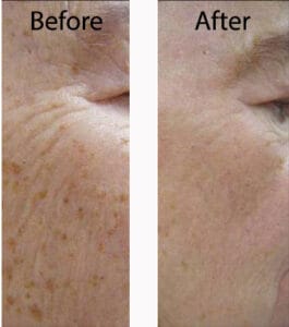 Typical treatment effects of IPL for brown spot removal