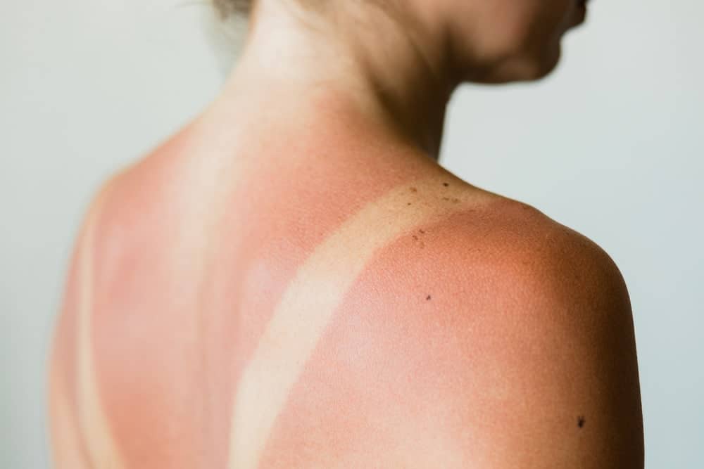 Repair Summer Sun Damage with an IPL Photofacial