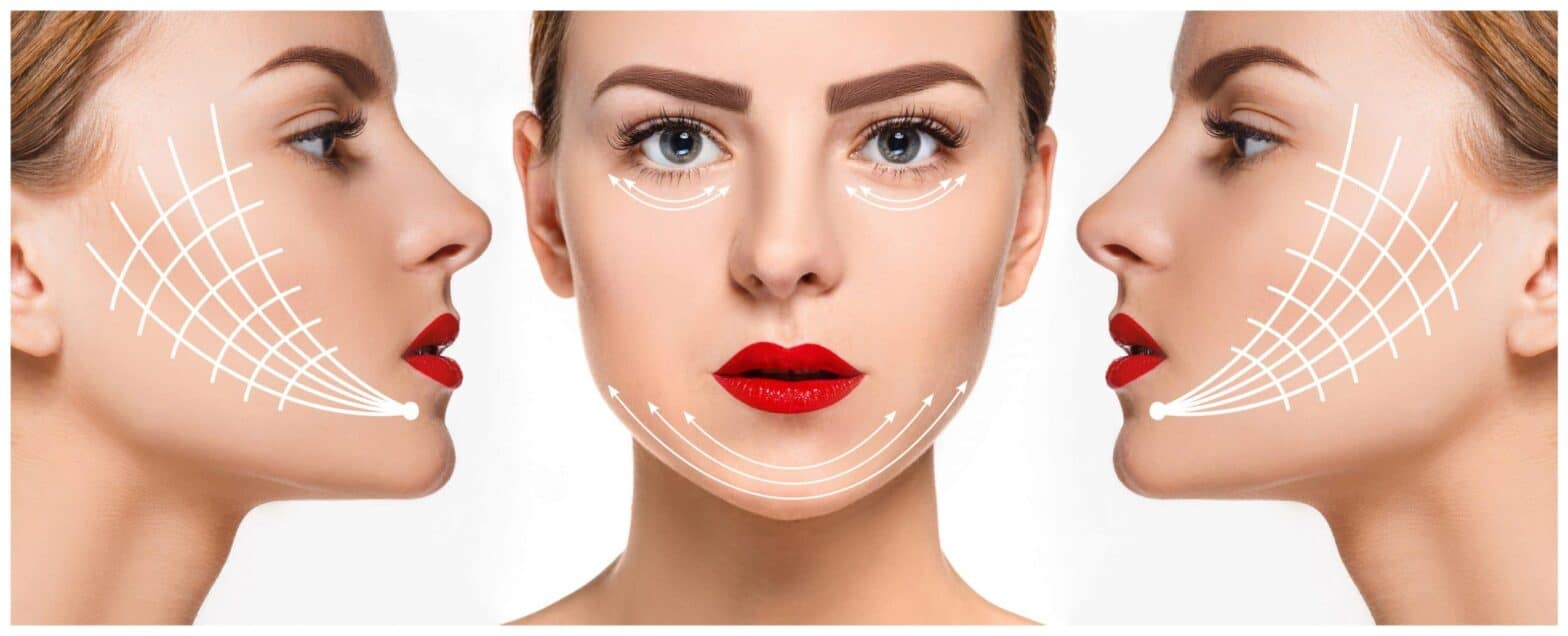 Is a Threadlift as Effective as a Traditional Facelift